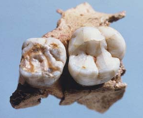 An image of the Neanderthal boy's teeth